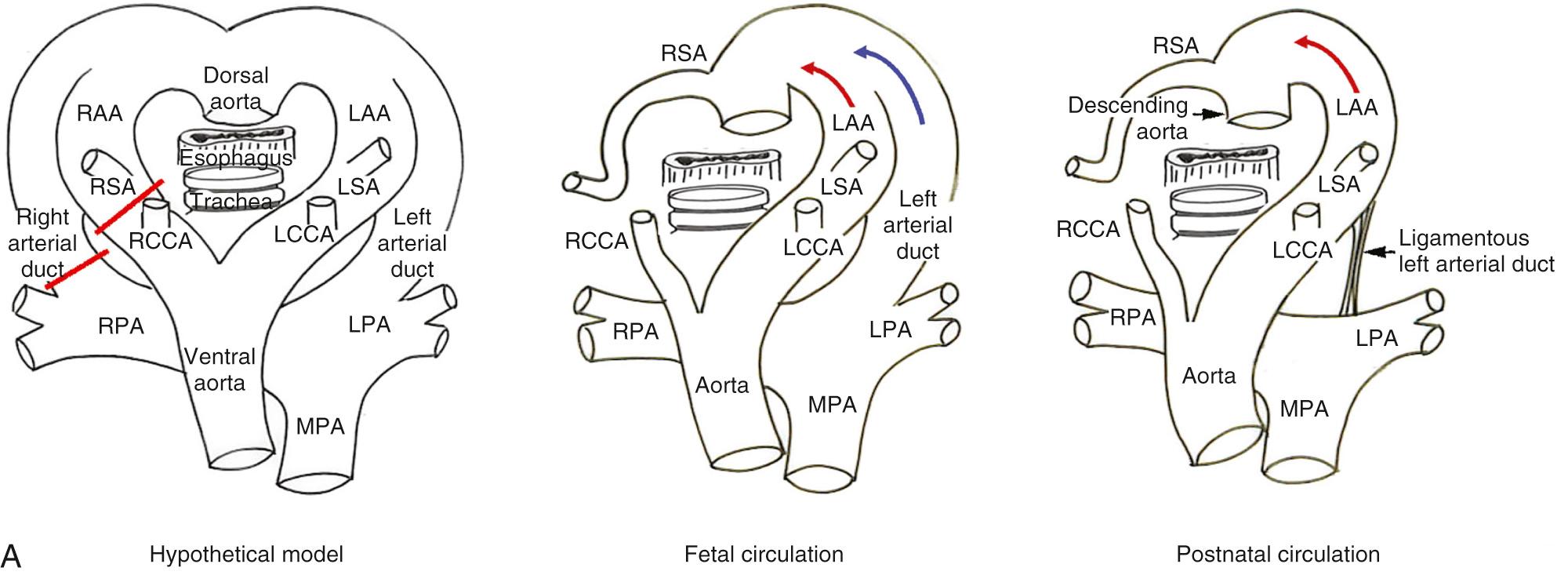 Fig. 47.6, (A) Morphogenesis (left) fetal arrangement (middle) and postnatal structure of left aortic arch (LAA) with aberrant origin of the right subclavian artery and left-sided arterial duct. In the hypothetical model, the red bars again indicate the segments that regress. In the fetal and postnatal circulations, a vascular sling is formed on the left side of the trachea and esophagus. (B) Computed tomograms show an LAA and aberrant right subclavian artery arising from the descending aorta, with no intervening diverticulum of Kommerell. The posterior wall of the trachea shows a shallow indentation from the aberrant right subclavian artery (right) . LCCA , Left common carotid artery; LPA , left pulmonary artery; LSA , left subclavian artery; MPA , main pulmonary artery; RAA , right aortic arch; RCCA , right common carotid artery; RPA , right pulmonary artery; RSA , right subclavian artery.