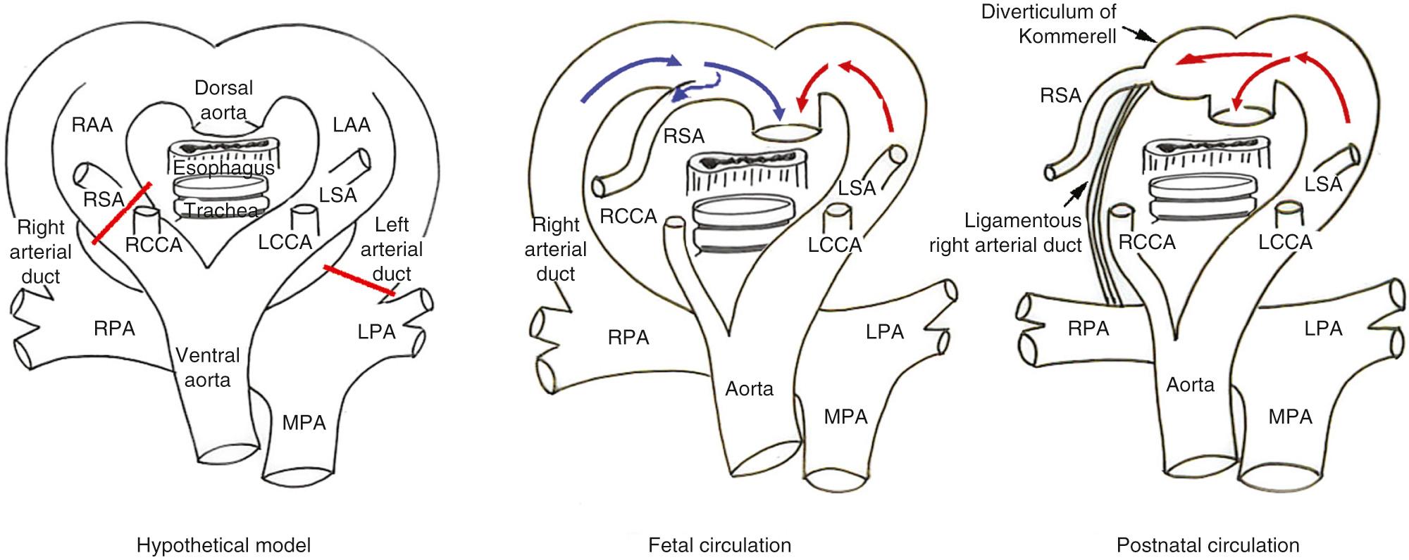 Fig. 47.7, Derivation and structures of left aortic arch (LAA) with aberrant right subclavian artery when the arterial duct is right sided. In the hypothetical model, the red bars again indicate the segments that regress. In the fetal circulation (middle) , the LAA, the distal remnant of the right aortic arch (RAA), the right-sided arterial duct, and the pulmonary trunk produce an L-shaped vascular loop around the trachea and esophagus. Because the two limbs of the L-shaped loop are attached to the heart, there is a complete vascular ring. In the postnatal circulation (right) , subsequent to closure of the arterial duct, the proximal part of the aberrant right subclavian artery, representing the distal remnant of the RAA, persists as a diverticulum of Kommerell. Note that, as with the previous situation, the flow in the distal remnant of the RAA switches its direction after birth. LCCA , Left common carotid artery; LPA , left pulmonary artery; LSA , left subclavian artery; MPA , main pulmonary artery; RCCA , right common carotid artery; RPA , right pulmonary artery; RSA , right subclavian artery.