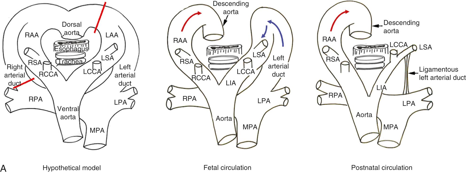 Fig. 47.8, (A) Morphogenesis, fetal arrangement, and postnatal structure of a right aortic arch (RAA) with mirror-image branching, the red bars in the hypothetical model indicating the segments that regress. In the majority of cases, it is the arterial duct on the left side that persists, with regression of the left aortic arch (LAA) distal to the origins of the left subclavian artery (LSA) and the left arterial duct, along with the right-sided arterial duct. In the postnatal circulation, the left-sided arterial ligament connects the base of the left brachiocephalic or subclavian artery to the left pulmonary artery (LPA). Persistence of the right-sided arterial duct is uncommon. (B) The computed tomograms, seen from above and the front, show the aortic arch on the right side of trachea. The aortic arch gives rise to the left brachiocephalic artery (LBA), right common carotid artery (RCCA), and right subclavian artery in sequence. The expected location of the ligamentous arterial duct is marked by a red bar (right) . Note that the LSA kinks inferiorly and the LPA is mildly stenotic, both highly suggestive of the presence of a left-sided arterial ligament. LCCA , Left common carotid artery; LIA , left innominate artery; MPA , main pulmonary artery; RPA , right pulmonary artery; RSA , right subclavian artery; SCV , superior caval vein.