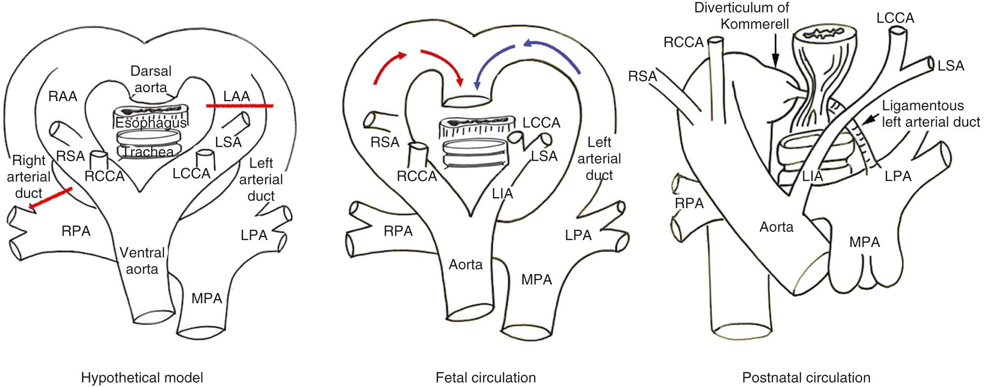 Fig. 47.9, Mode of formation of a right aortic arch (RAA) with mirror-image branching and retroesophageal course of the left-sided arterial duct between the right-sided descending aorta and the left pulmonary artery (LPA). In the hypothetical model (left), the red bars indicate the regression of the left aortic arch (LAA) between the origins of the left subclavian artery (LSA) and the left arterial duct, along with the right arterial duct. In the fetal circulation (middle), a U-shaped vascular loop is formed around the posterior aspect of the trachea and esophagus. In postnatal circulation (right) , the left-sided arterial duct arises from the right-sided descending aorta via a diverticulum of Kommerell, extending to the LPA to produce a complete vascular ring in this rare anomaly. LCCA , Left common carotid artery; LIA , left innominate artery; MPA , main pulmonary artery; RCCA , right common carotid artery; RPA , right pulmonary artery; RSA , right subclavian artery.