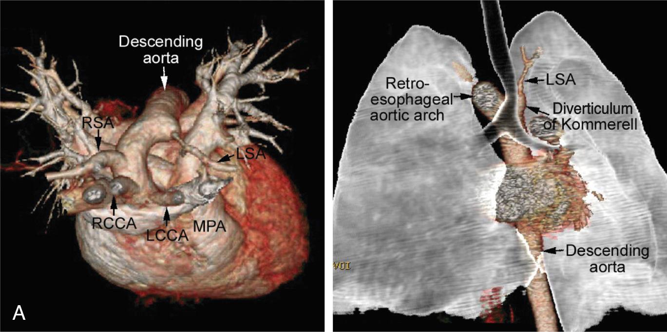 Fig. 47.10, (A) Computed tomograms showing a circumflex and retroesophageal right-sided aortic arch. The aortic arch is located on the right side of the trachea and makes a sharp oblique leftward and downward turn to course behind the esophagus to connect to the left-sided descending aorta. The left subclavian artery (LSA) arises from the top of the descending aorta, with the presence of a diverticulum suggesting that a left-sided arterial ligament is present between the apex of the diverticulum and the proximal left pulmonary artery (LPA). (B) Rendering of this arrangement. LCCA , Left common carotid artery; LVA , left vertebral artery; MPA , main pulmonary artery; RAA , right aortic arch; RCCA , right common carotid artery; RPA , right pulmonary artery; RSA , right subclavian artery; RVA , right vertebral artery.