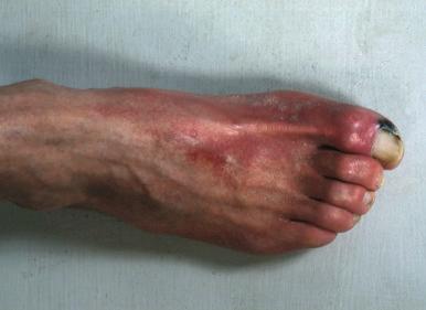 Figure 46-1, Critically ischemic foot with characteristic hyperemia (“sunset foot”) and tissue loss.