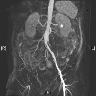 Figure 46-2, Magnetic resonance angiogram demonstrating occlusion of the right iliac system with the common femoral artery bifurcation filled via collateral circulation.