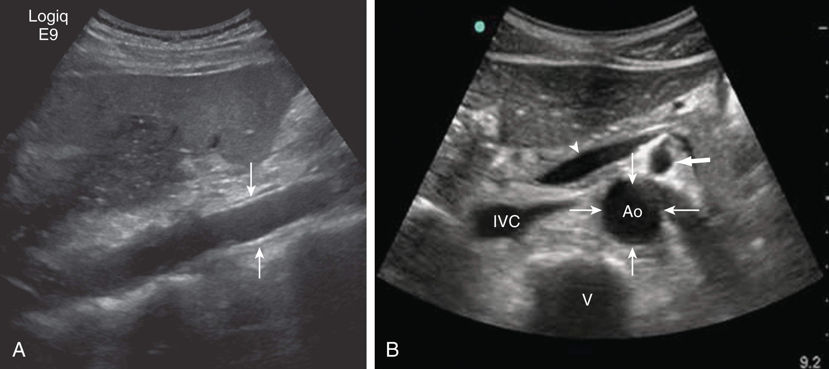 Fig. 8.11, (A) Outer to outer measurements should be taken of the aorta in the longitudinal (A) and transverse (B) planes. Ao , Aorta; IVC , inferior vena cava; thick arrow , superior mesenteric artery; V , vertebra; arrowhead , splenic vein.