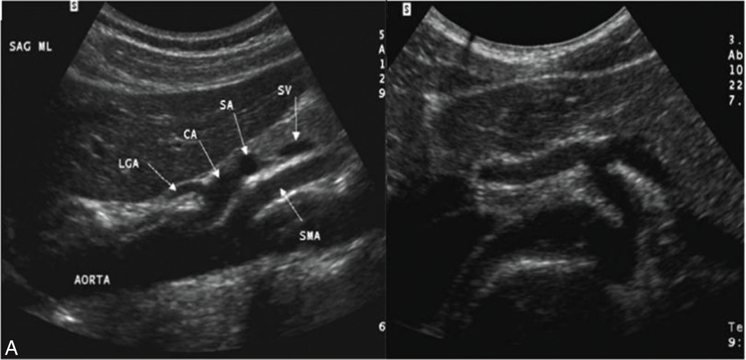 Fig. 8.16, (A–C) The celiac trunk may be visualized sonographically on transverse or longitudinal images. It is usually seen as a small vascular structure arising anteriorly from the abdominal aorta just below the diaphragm. The superior mesenteric artery is just inferior to the origin of the celiac trunk. Ao , Aorta; CA , celiac artery; CHA , common hepatic artery; IVC , inferior vena cava; LGA , left gastric artery; SA , splenic artery; SMA , superior mesenteric artery; SV , splenic vein.