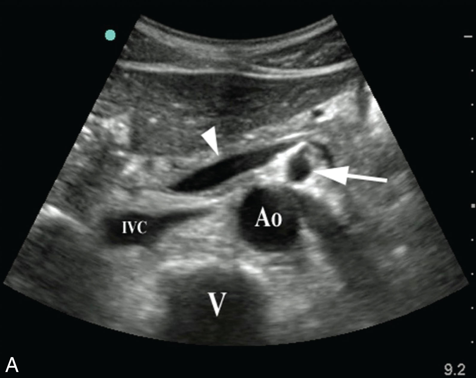 Fig. 8.20, (A–B) The superior mesenteric artery (SMA) is well seen on both transverse and longitudinal scans as it arises from the anterior aortic wall. The SMA branches off the anterior wall of the aorta at a slight angle and then follows a parallel course. Transversely, the artery can be seen as a separate small, circular structure anterior to the abdominal aorta and posterior to the pancreas. Characteristically, it is surrounded by highly reflective echoes from the retroperitoneal fascia. (C) Color Doppler in the sagittal plane shows the aorta with the celiac trunk and SMA. (D) Adenopathy should be considered if the angle of the superior mesenteric to the aorta is greater than 15 degrees. Ao , Aorta; IVC , inferior vena cava; V , vertebra.