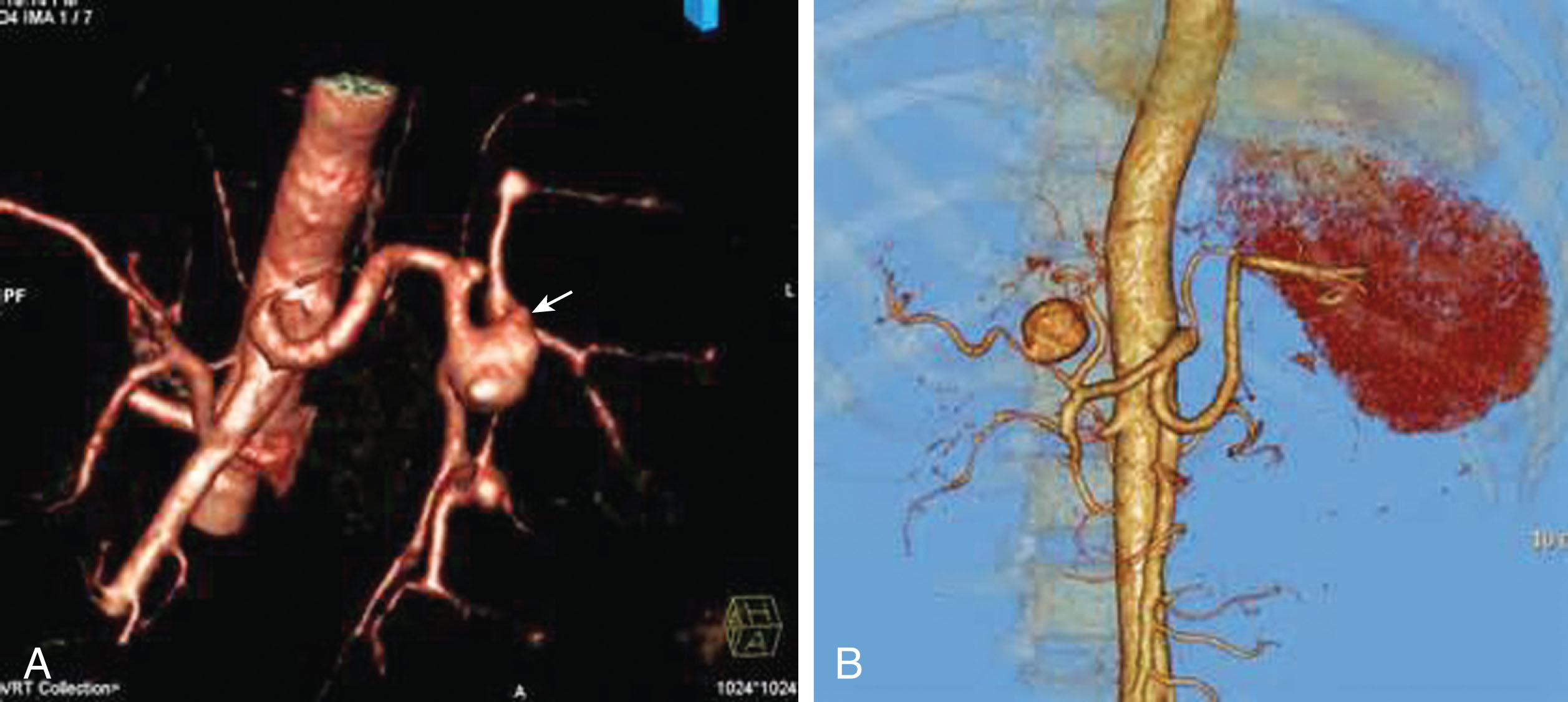 Fig. 8.22, (A) The splanchnic aneurysms may be atherosclerotic, posttraumatic, mycotic, congenital, or inflammatory. (B) Small aneurysm of the hepatic artery.