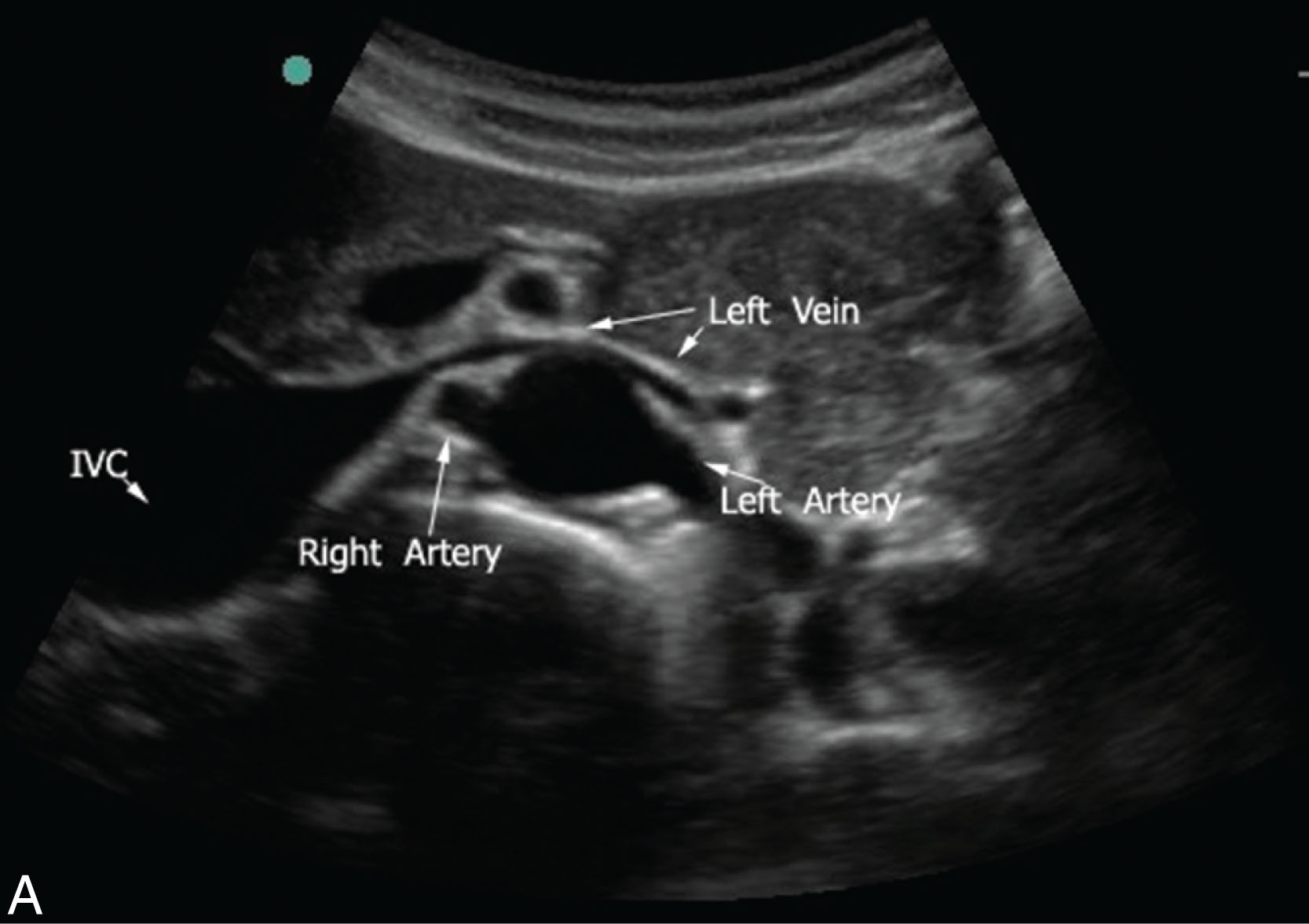 Fig. 8.25, (A–B) The left renal artery courses from the aorta directly into the hilus of the left kidney. AO , Aorta; IVC , inferior vena cava; LRV , left renal vein; RRA , right renal artery; SV , splenic vein; SMA , superior mesenteric artery.