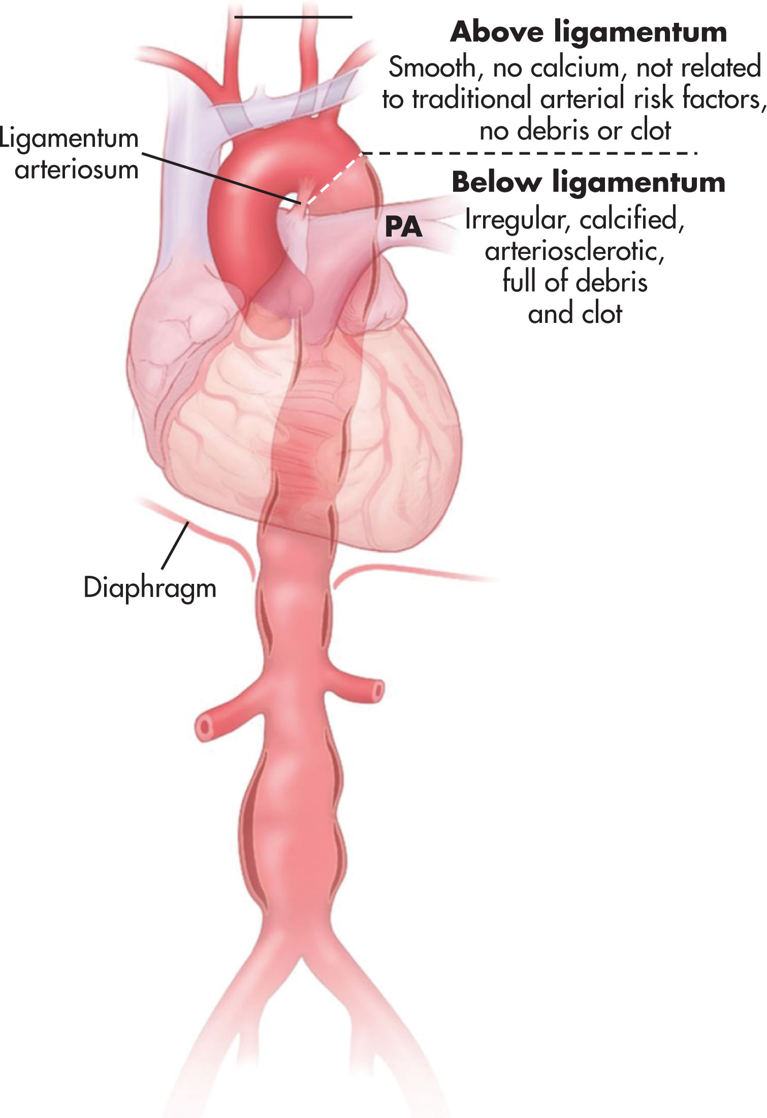 Fig. 8.26, Ectasia implies the diffuse dilation of a vessel, whereas an abdominal aortic aneurysm is a region of focal enlargement. PA , Pulmonary artery.
