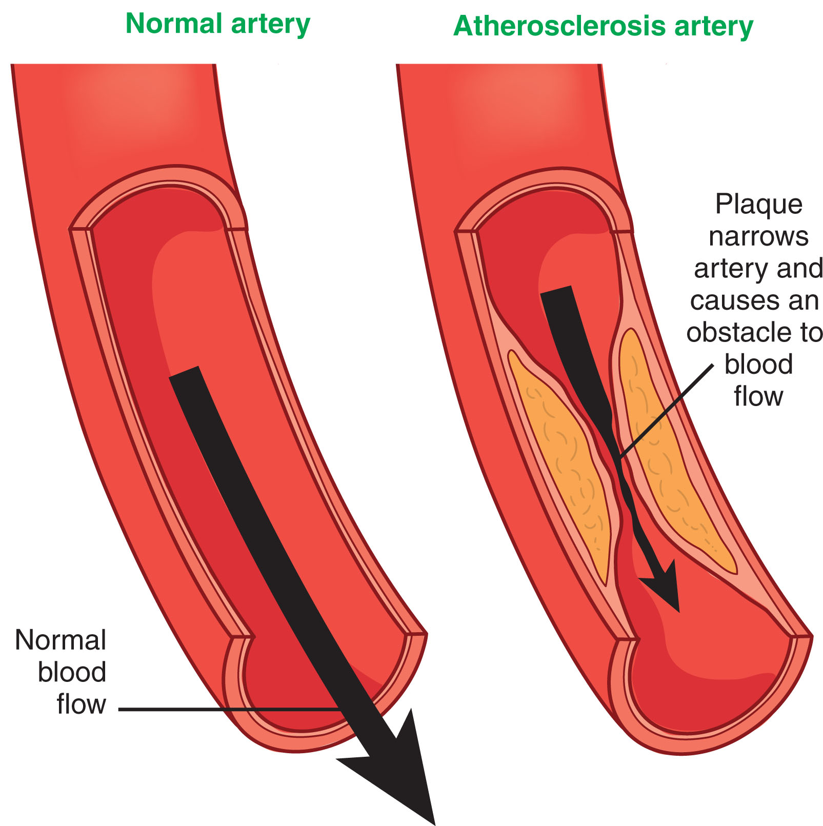 Fig. 8.27, Arteriosclerosis occurs when the arterial vascular system becomes thick and stiff, which can lead to restriction of blood flow to the organs and tissues in the body. Atherosclerosis is a specific form of arteriosclerosis.