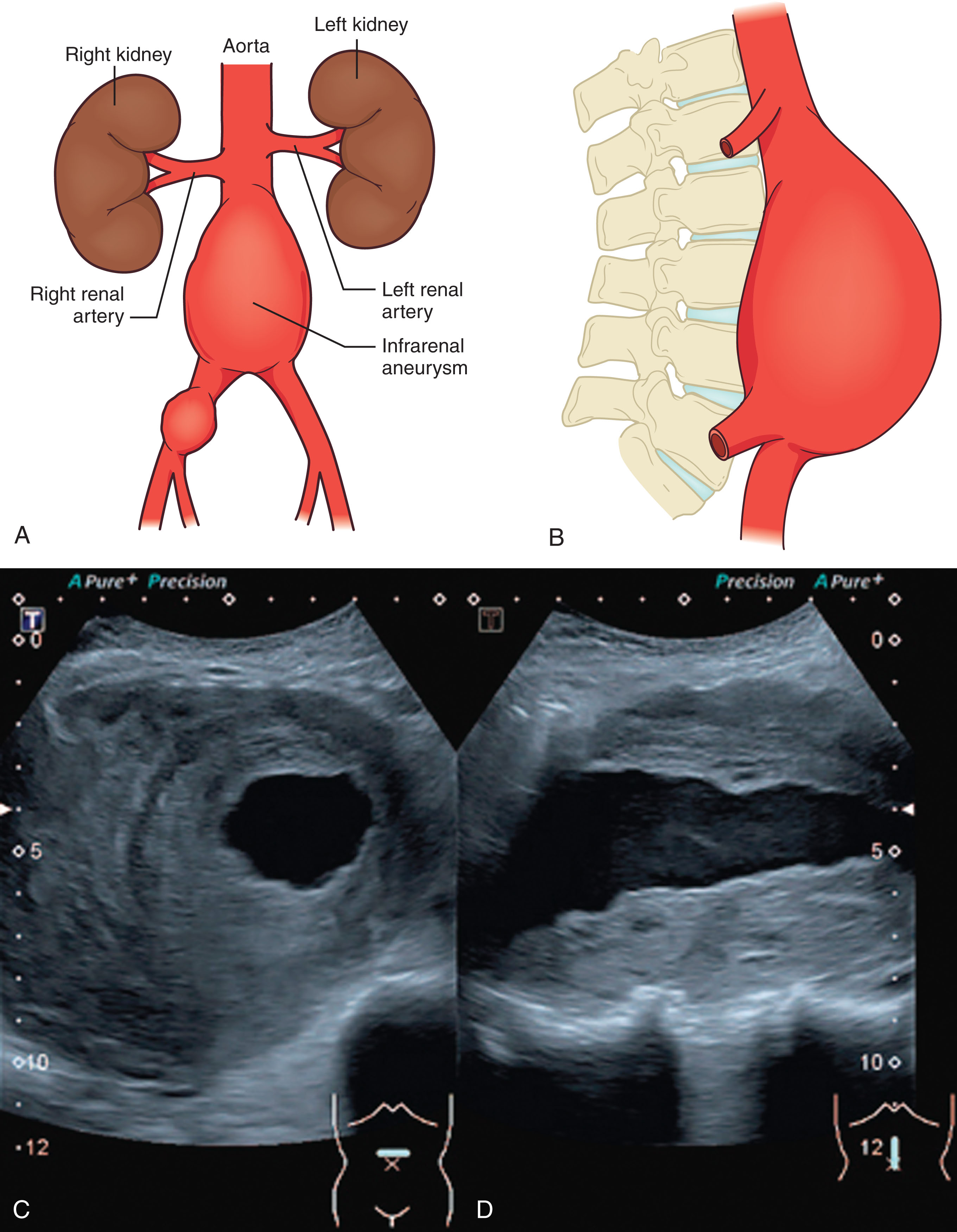 Fig. 8.28, (A–B) An aortic aneurysm is defined as that with a vessel diameter greater than 3 cm or noted focal dilation of the vessel. (C) Transverse and (D) longitudinal sonographic images of the aortic aneurysm with circumferential thrombus.