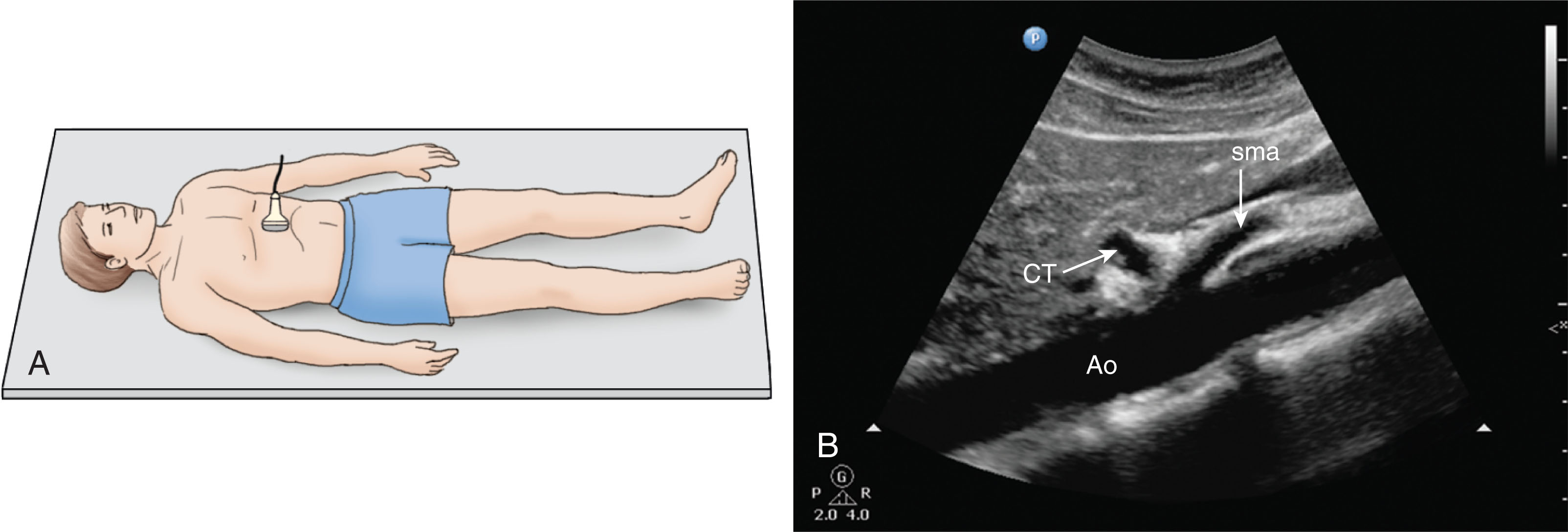 Fig. 8.7, (A) To begin the sonographic evaluation of the abdominal aorta, the patient is usually imaged first in the longitudinal plane. (B) Longitudinal image of the abdominal aorta (Ao) with the celiac trunk (CT) and superior mesenteric artery (sma) arising from the anterior wall. (C) The aorta is imaged as a long pulsatile tubular structure that lies just anterior and to the left of the spine. (D) The abdominal aorta gives rise to two important branches from the anterior wall: the celiac trunk and the superior mesenteric artery.