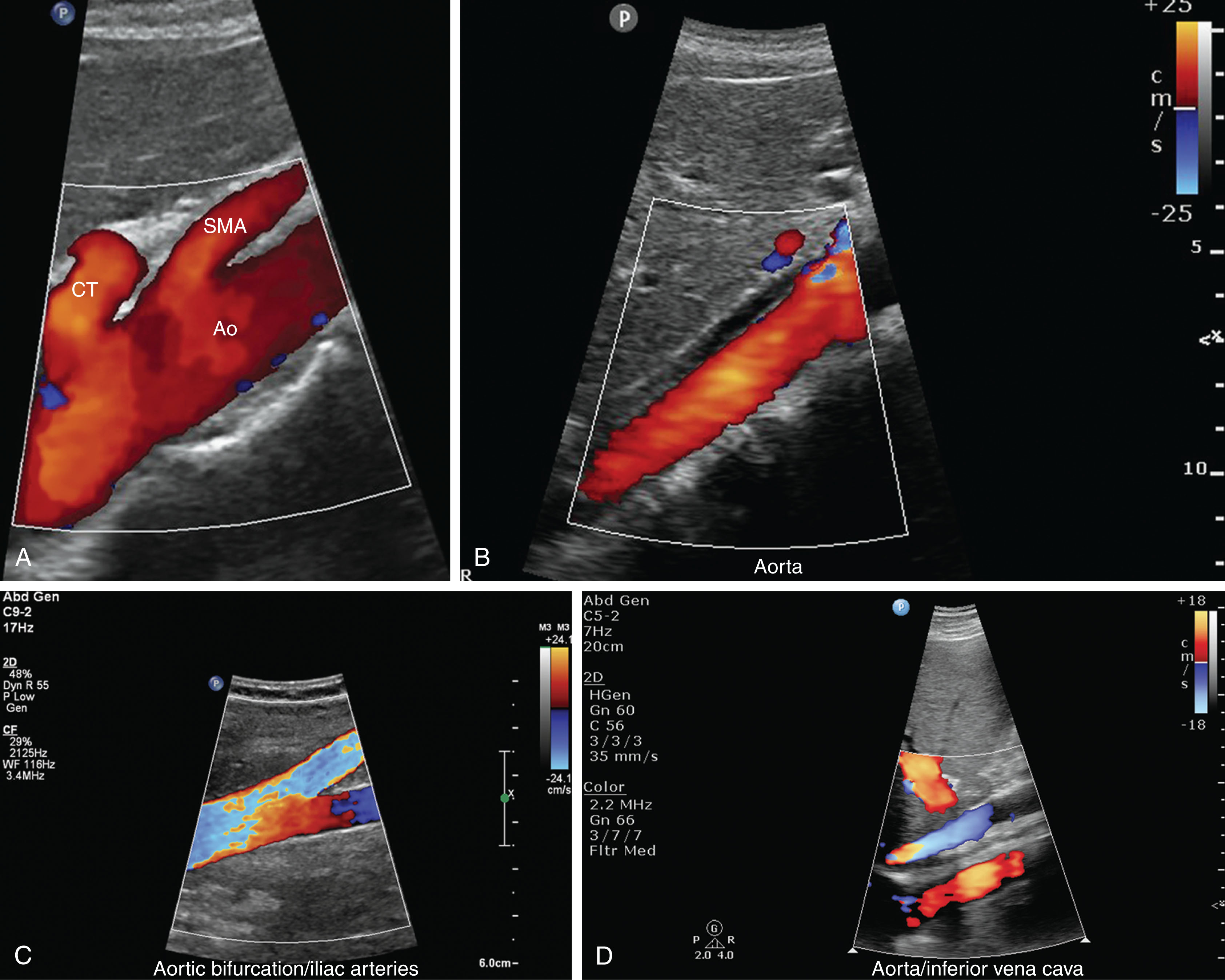 Fig. 8.8, (A) Color Doppler longitudinal image of the abdominal aorta (Ao) with the celiac trunk (CT) and superior mesenteric artery (SMA) arising from the anterior border. (B) Color Doppler of the normal aorta. (C) Color Doppler of the bifurcation of the aorta into the iliac arteries. (D) Coronal oblique view of the inferior vena cava (blue) anterior to the aorta (red) .