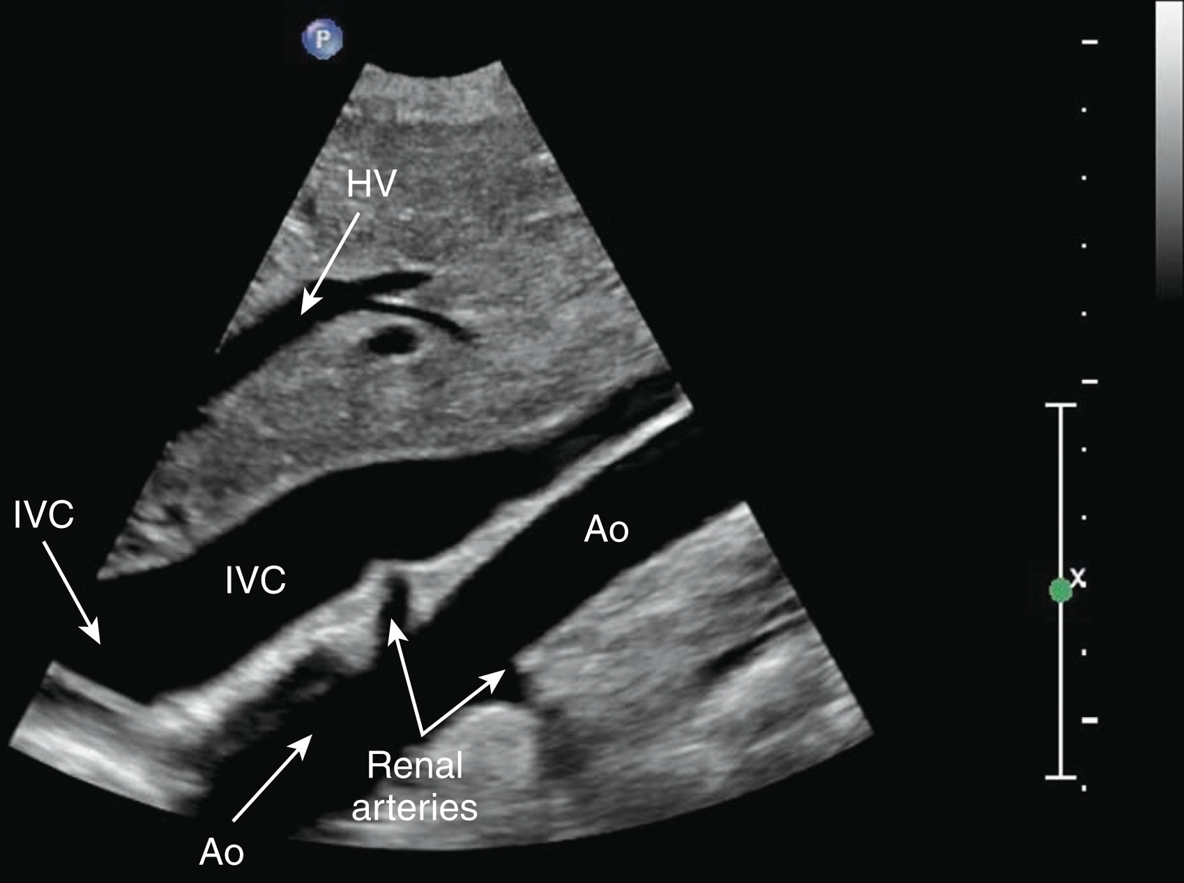 Fig. 8.9, Coronal image with the transducer slightly angled toward the midline to see the inferior vena cava (IVC) anterior to the aorta (Ao) and renal arteries. HV , Hepatic vein.