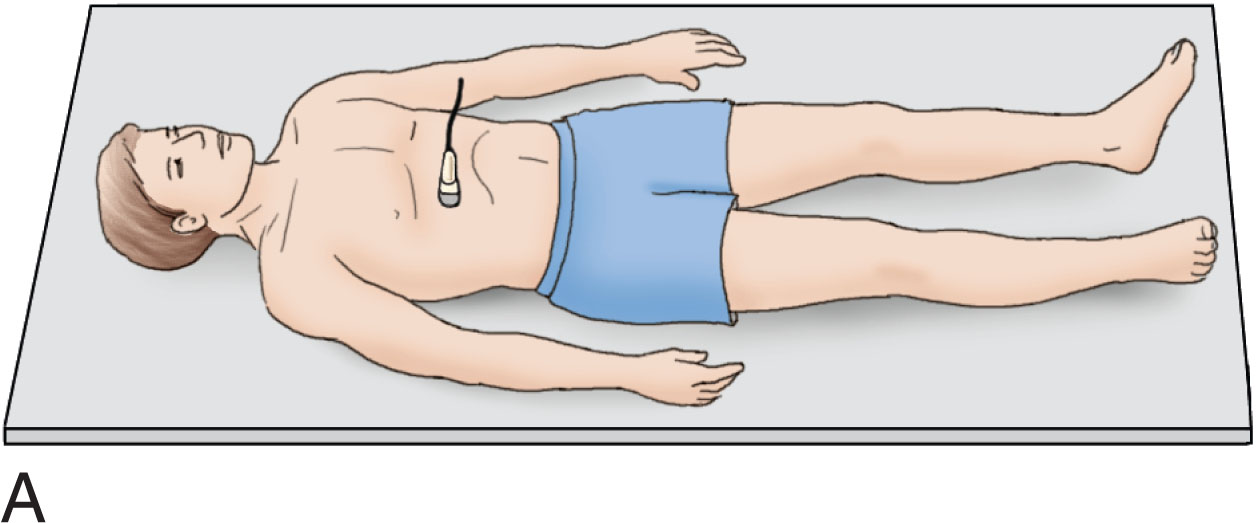 Fig. 8.10, (A) Transverse plane. Multiple scans should be made from the xiphoid to the bifurcation to record the dimensions of the aorta. (B) The celiac trunk (orange arrows) , hepatic artery (green arrow) , and splenic artery (yellow arrow) are a good landmark for the upper aorta. (C) The left renal vein is seen inferior to the celiac trunk image. (D) The mid-abdominal image shows the aorta (hashmarks) to the left of the inferior vena cava. (E) Inferior margin of the abdominal aorta just before the bifurcation.