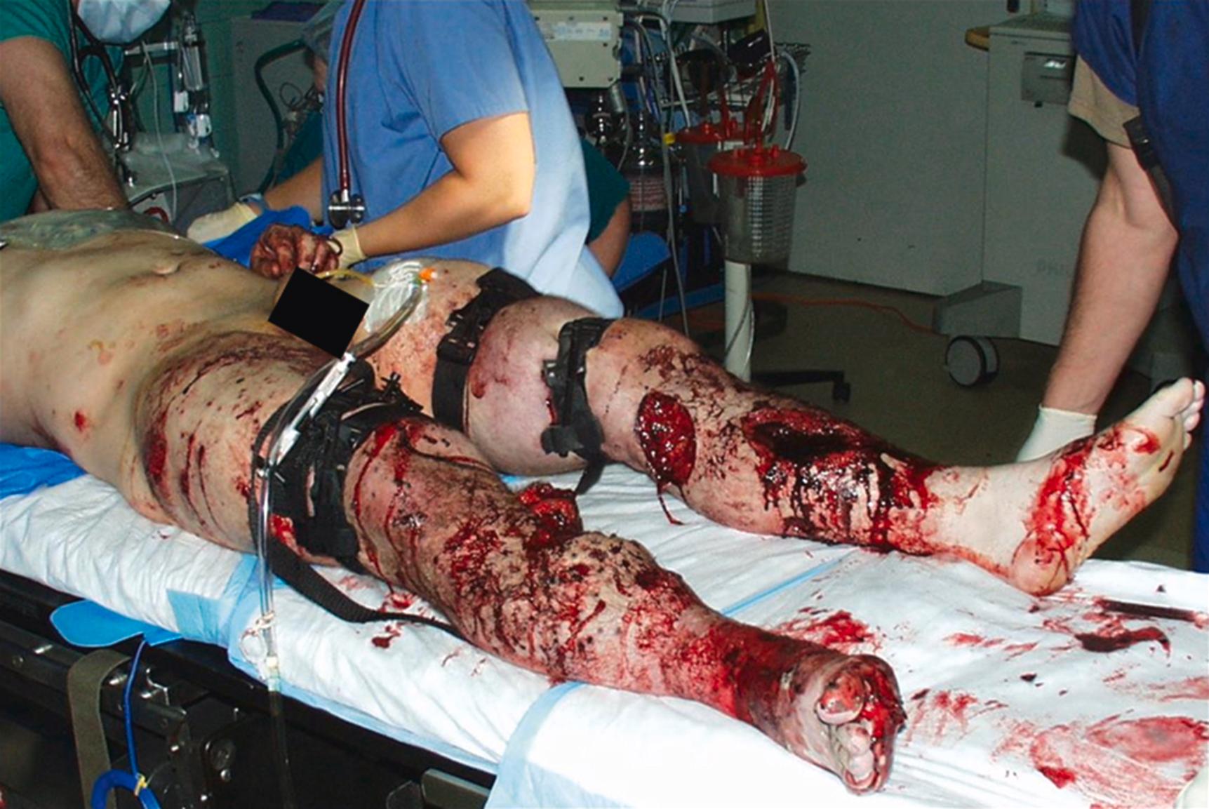 Figure 179.1, Optimal hemorrhage control for military trauma is achieved with early placement of pre-hospital tourniquets for extremity wounds and timely resuscitation with blood products.