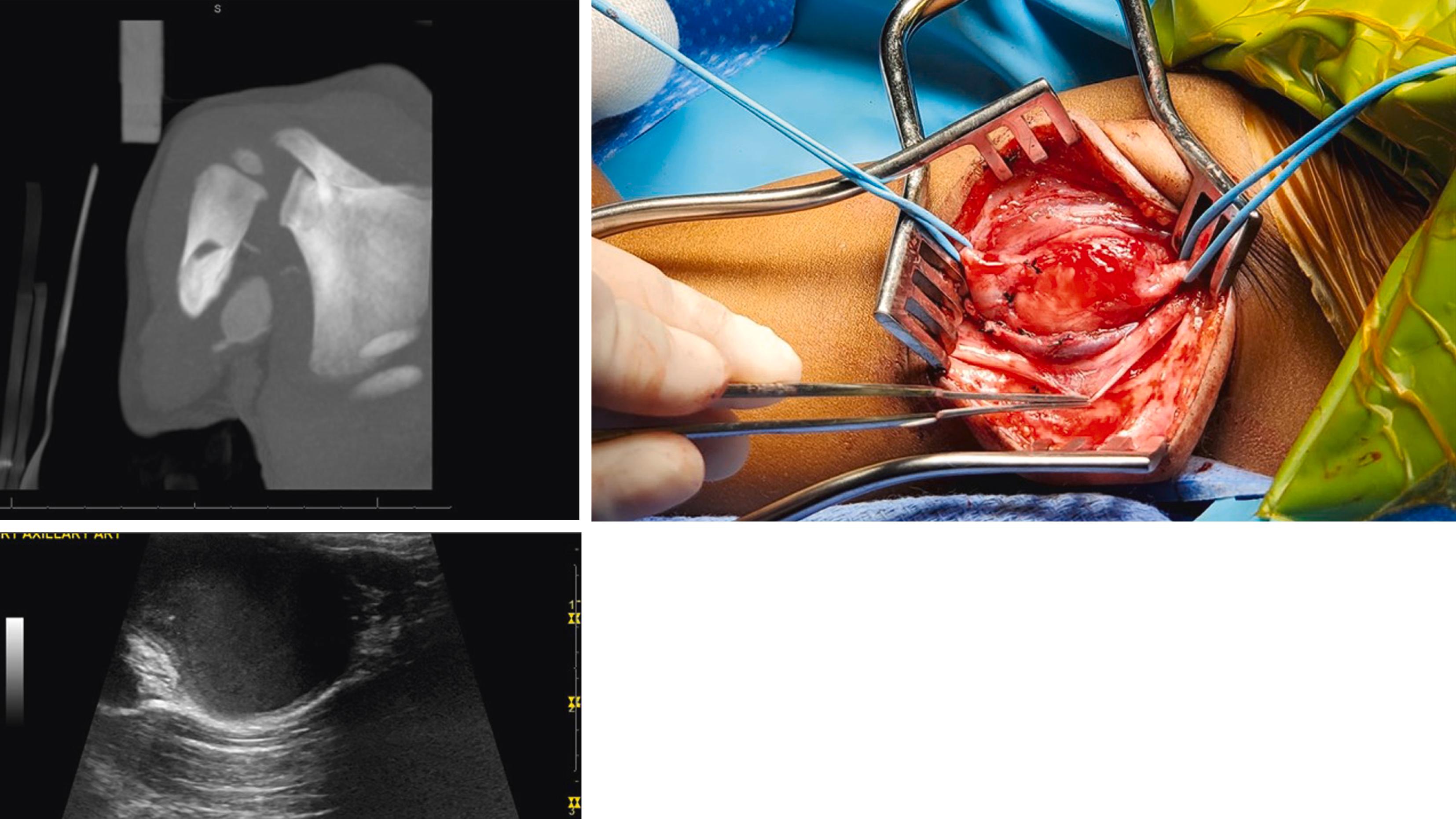 Figure 188.1, Iatrogenic injury in a 7-month-old child who had multiple lines and developed a large brachial pseudoaneurysm that was resected with end-to-end anastomosis of the brachial artery.