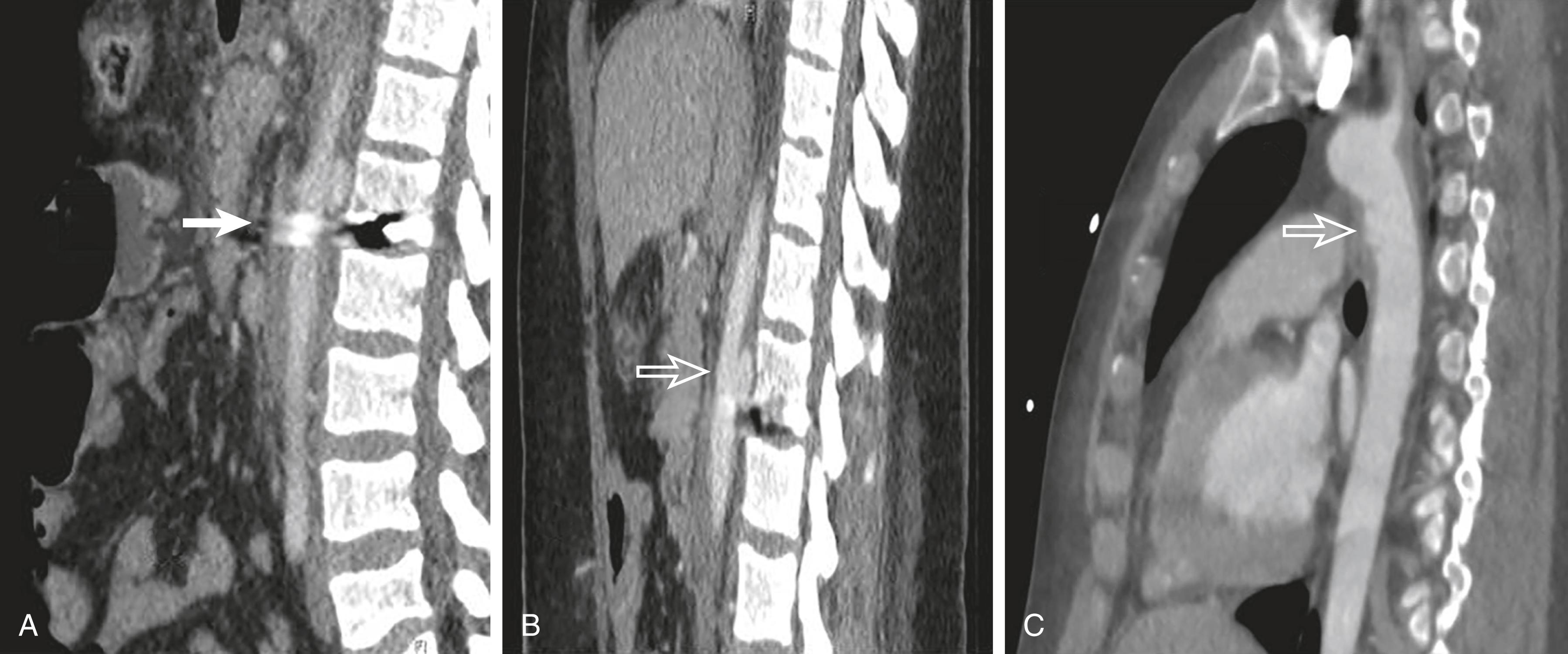 Figure 188.2, Utilization of CTA in Detecting Arterial Truncal Injuries.