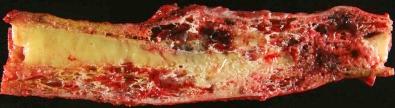 Figure 13-1, Arteriovenous malformation involving a resected segment of a long bone. It consists of large vessels that course through and disrupt the cortex and medullary cavity.