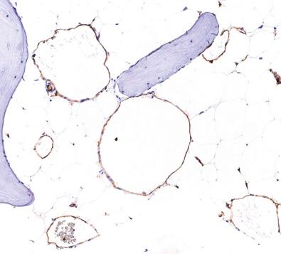 Figure 13-11, The endothelial cells of a cavernous hemangioma express CD31.