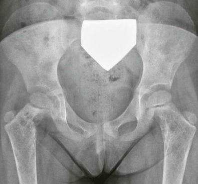 Figure 13-13, Lymphangiomatosis presenting as multiple oval radiolucencies in both proximal femurs and pelvis.