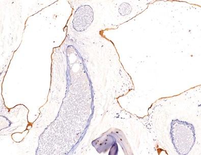 Figure 13-15, Endothelial lining cells in a lymphangioma expressing D2-40.