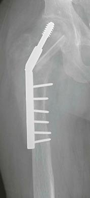 Figure 13-16, Gorham disease previously treated with a fibular strut graft and metal hardware. The tumor has resulted in resorption of much of the proximal femur.