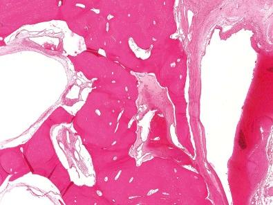 Figure 13-2, Large dilated veins of an arteriovenous malformation grow into the cortex, resulting in significant bone resorption.