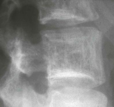 Figure 13-3, Lateral view of the spine demonstrating a hemangioma of the vertebral body that manifests as sclerosis of the vertically oriented bony trabeculae, producing a corduroy-like appearance.