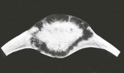 Figure 13-4, A specimen radiograph of a hemangioma of the calvarium shows the lytic tumor expanding the bone with associated prominent central sclerosis that has a sunburst-like appearance at the periphery.