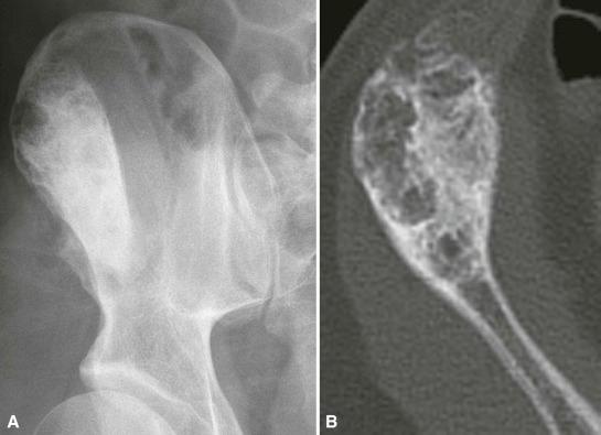 Figure 13-5, A, Hemangioma of the ilium presents as a mixed lytic and sclerotic mass that has a trabeculated pattern of mineralization. B, Computed tomography shows expansion of the bone and the honeycomb pattern of reactive bone that is present within the tumor.