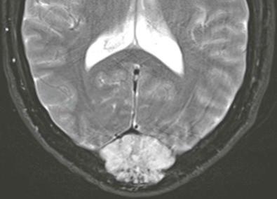 Figure 13-6, Hemangioma of the calvarium has high signal intensity on this axial T2-weighted, fat-saturated magnetic resonance image. The tumor impinges on the surface of the brain.