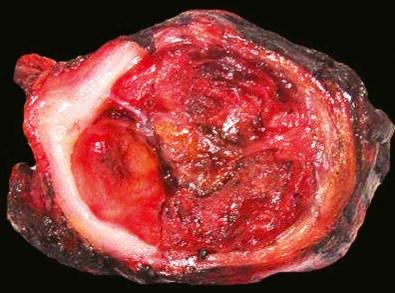 Figure 13-7, Hemangioma expands the rib and appears as a granular red-tan mass.