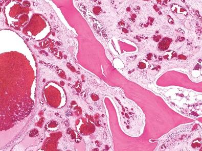 Figure 13-8, Cavernous hemangioma replaces the marrow and surrounds preexisting bony trabeculae.