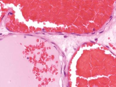 Figure 13-9, Endothelial lining of cavernous hemangioma consists of bland spindle cells.