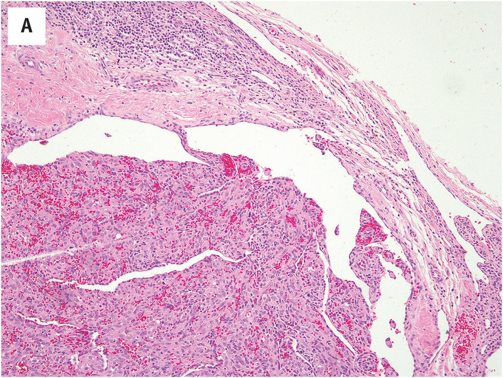 Fig 10.1, (A) Intravascular papillary endothelial hyperplasia displaying the cellular proliferation of benign endothelial cells within an organizing thrombus. (B-C) High-power view of papillary endothelial hyperplasia. Note the bland cytologic features of the endothelial cells and the absence of endothelial cell stratification.