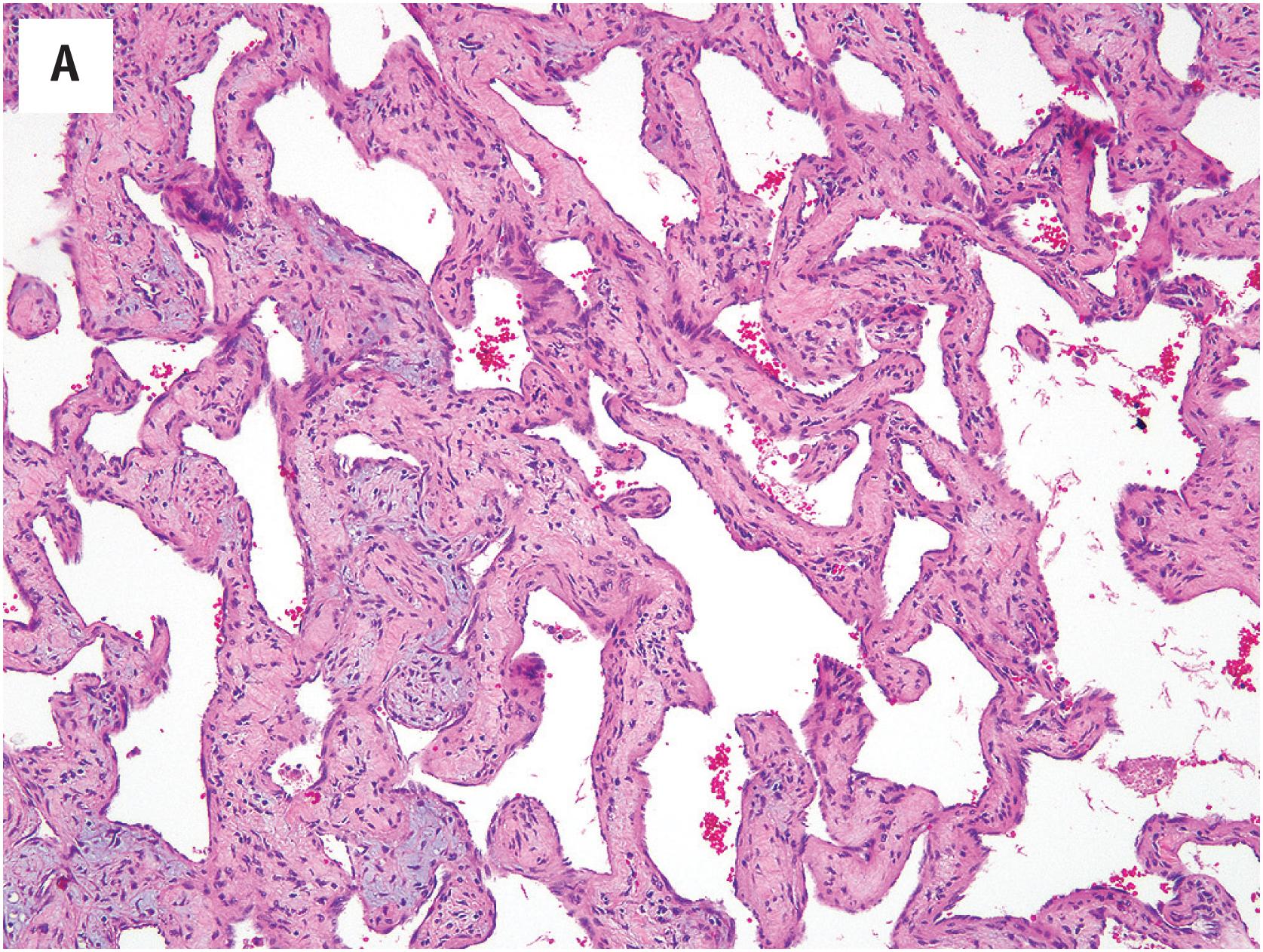 Fig. 10.13, (A) Cavernous hemangioma showing a characteristic “sieve-like” growth pattern. (B) Vascular channels with fibrous walls, lined by flattened endothelial cells in cavernous hemangioma.