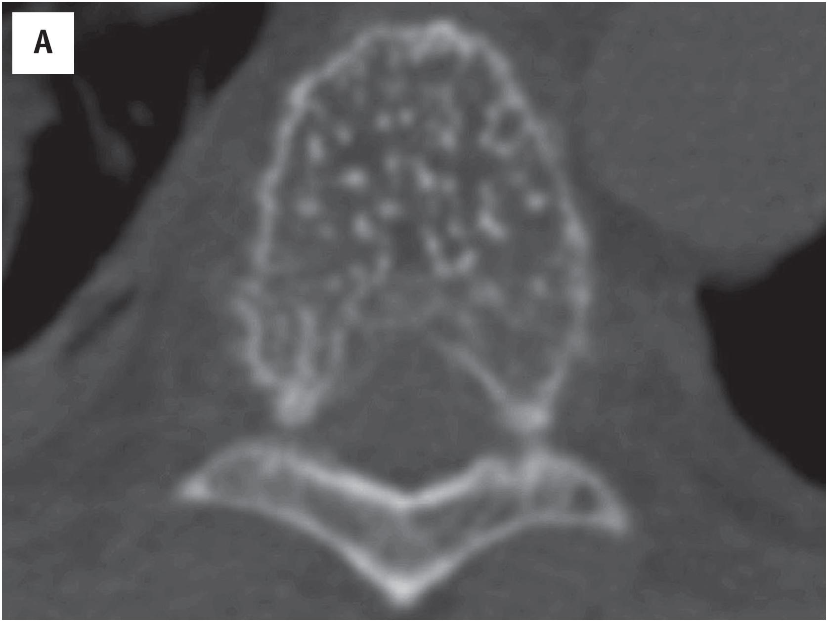 Fig. 10.15, (A) Axial CT image of a hemangioma of bone involving the T6 vertebra, with a “polka dots”-like appearance. (B) Gross photograph of a vertebral hemangioma, which is demarcated, sponge-like, and fills the medullar cavity.