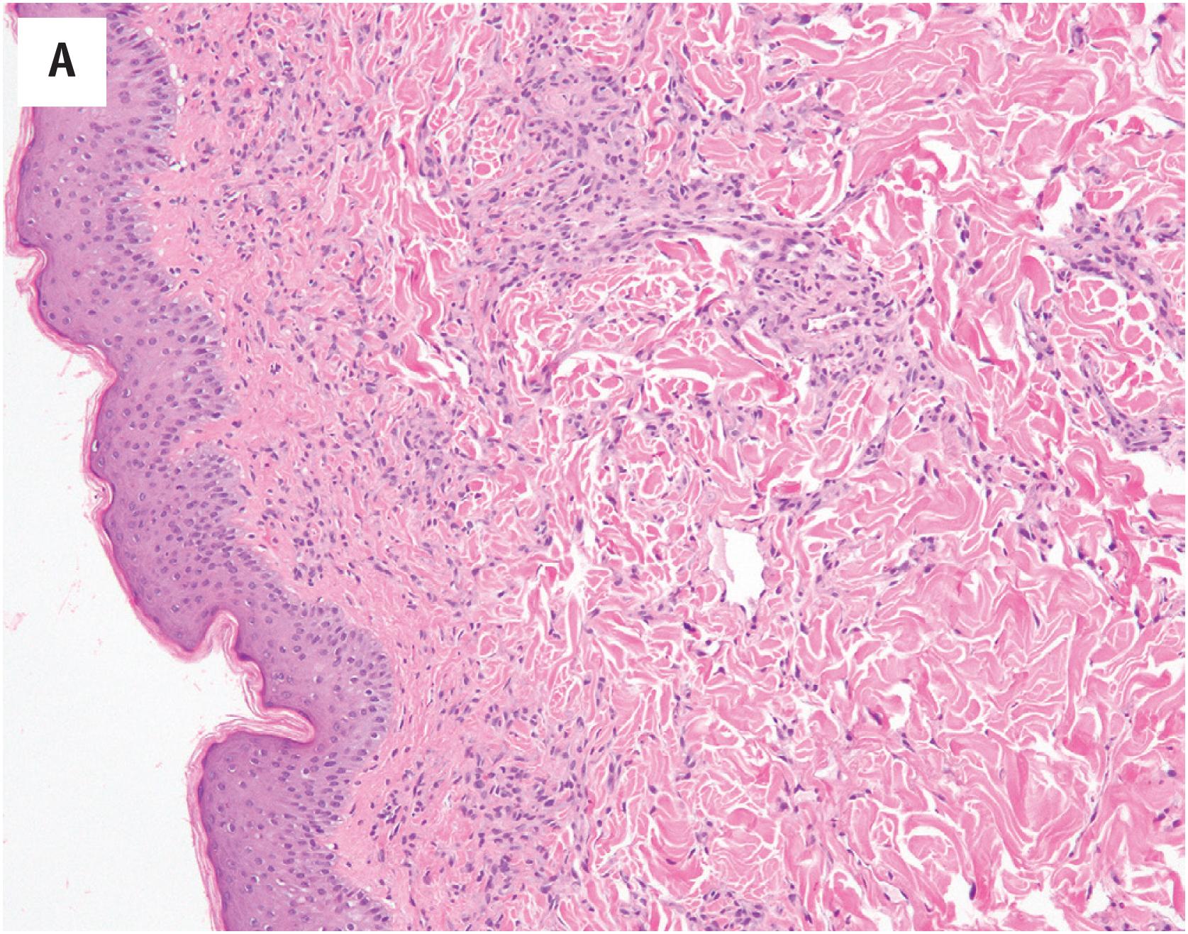 Fig. 10.4, (A) Diffuse dermal angiomatosis (DDA), consisting of a florid proliferation of small capillaries in the dermis. (B) The presence of infiltrative growth may raise concern for well-differentiated angiosarcoma. (C) However, the capillaries of DDA are well-formed, lack atypical endothelial cells, and are uniformly invested by smooth muscle, reassuring findings. (D) In cases of DDA associated with calciphylaxis, the deeper vessels may show calcification.