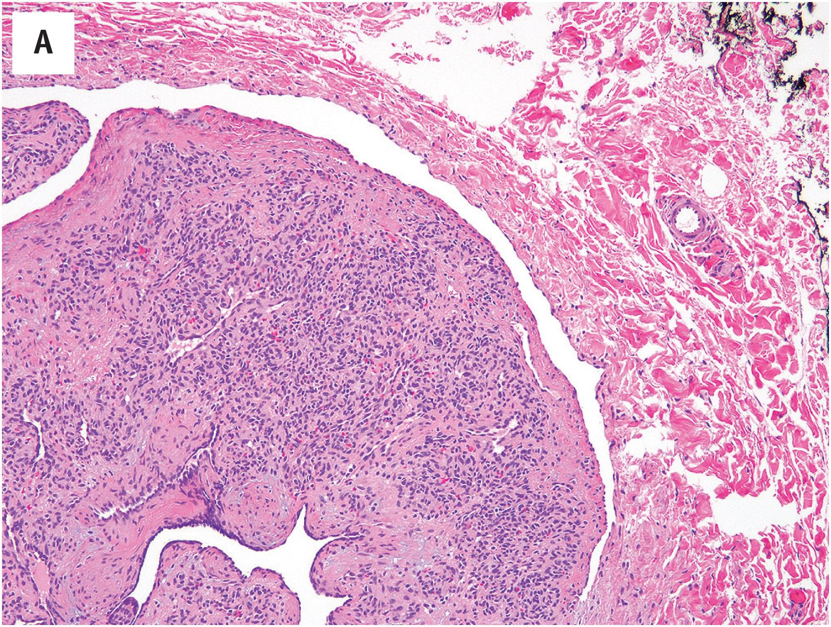 Fig. 10.6, (A) Intravascular pyogenic granuloma (intravascular lobular capillary hemangioma). (B) As in their more common extravascular counterparts, intravascular pyogenic granulomas display a lobular growth pattern of well-formed capillaries.