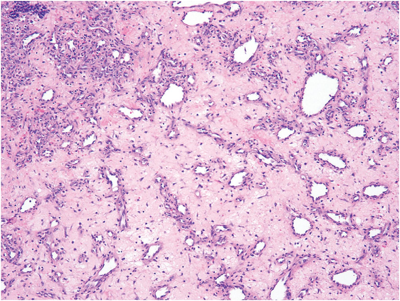 Fig. 10.7, Intranasal lobular capillary hemangioma (pyogenic granuloma) with myxohyaline stromal change.