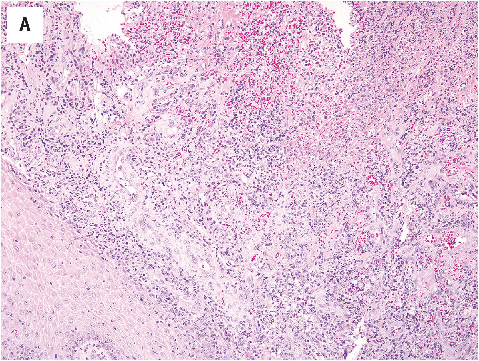 Fig. 10.8, (A) Bacillary angiomatosis, presenting as an ulcerated dermal nodule composed of blood vessels lined by epithelioid endothelial cells in association with marked acute inflammation. (B) High-power view of bacillary angiomatosis, exhibiting epithelioid endothelial cells, neutrophils, and eosinophilic debris.