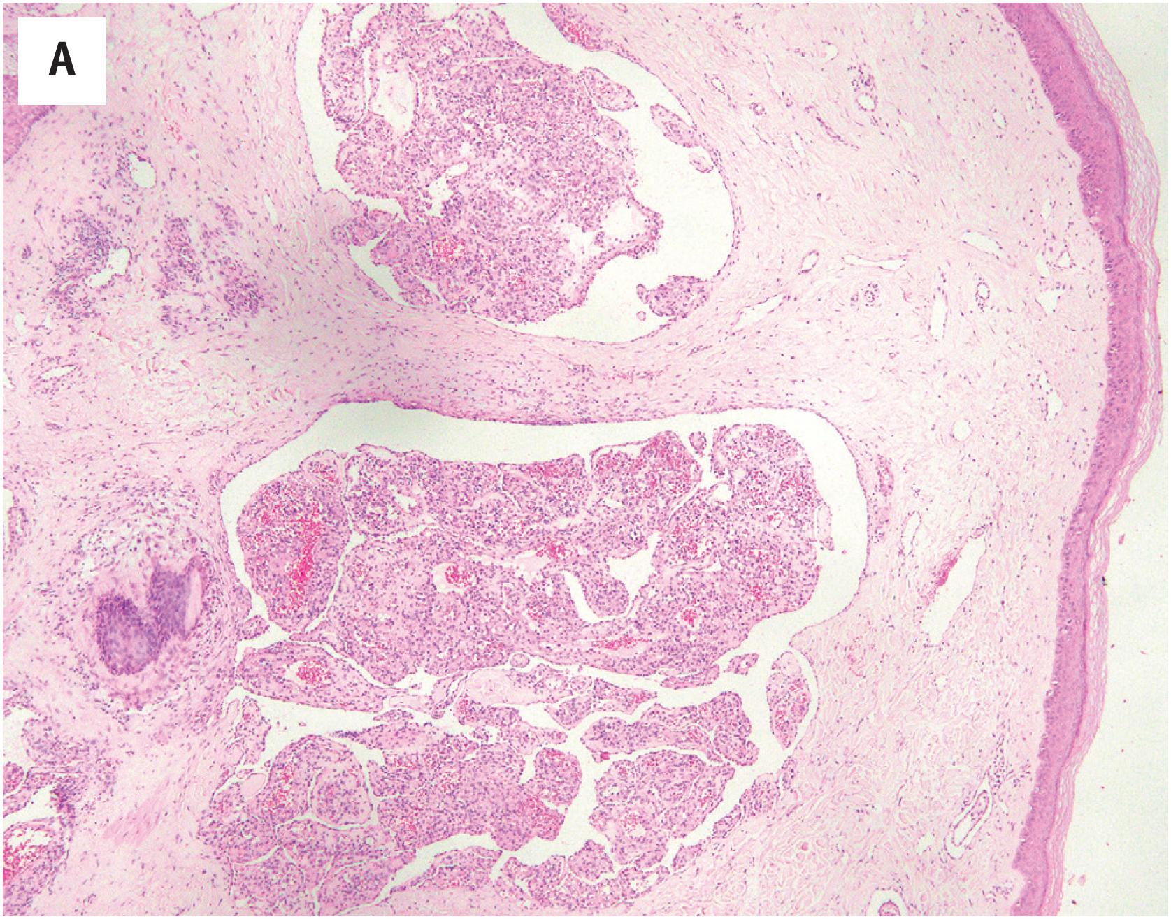 Fig. 10.9, (A) Glomeruloid hemangioma, consisting of an unusual intradermal proliferation of small capillary clusters, resembling glomeruli. (B) The papillae are lined by bland, plump endothelial cells containing intracytoplasmic globules. (C) PAS-D stain, highlighting the intracytoplasmic globules of polyphenotypic immunoglobulin.