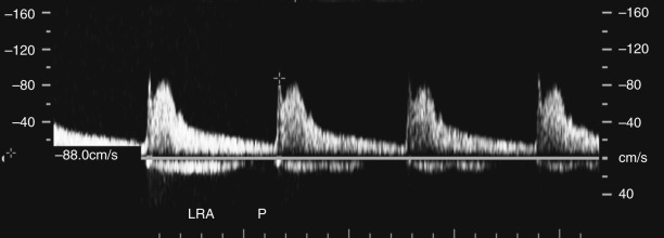 Figure 64-1, Normal low-resistance spectral Doppler waveform of main renal artery with broad systolic peak, gradual transition between systole and diastole, and persistent forward diastolic flow.