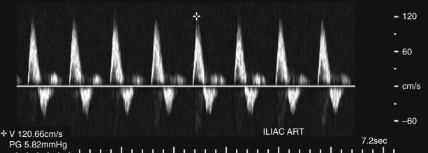 Figure 64-2, Normal high-resistance spectral Doppler waveform of external iliac artery with narrow systolic peak, abrupt transition between systole and diastole, transient reversal of diastolic flow, and return of low-level forward flow during rest of diastole.