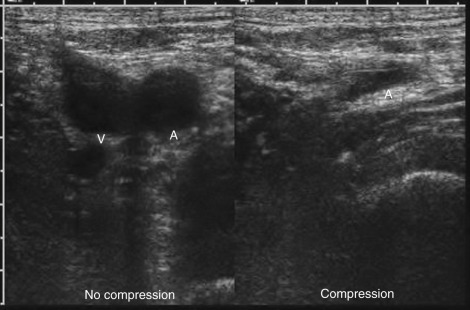 Figure 64-3, Normal venous compression on US. Transverse gray scale US image of left common femoral artery ( A ) and vein ( V ) without compression and with compression. The normal vein completely collapses with compression.