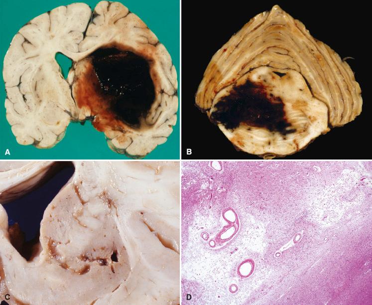 Fig. 26.5, (A) Large acute hypertensive hemorrhage centered on the basal ganglia. (B) Acute hypertensive hemorrhage arising in the pons. (C) Slit-like lacunar infarct of putamen, caudate, and internal capsule. (D) Low-magnification view of a well-circumscribed remote lacunar infarct with liquefactive necrosis, surrounding hyalinized blood vessels.