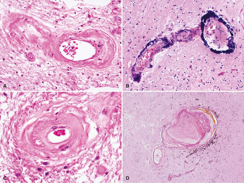 Fig. 26.6, (A) Arteriosclerosis. Fibrointimal sclerosis involving a small parenchymal artery in a patient with hypertension. (B) Vascular calcification. Heavily calcified small arteries of the globus pallidus. This nonspecific change can be seen in patients with hypertension. (C) Hyalinization (“lipohyalinosis”) of a small, white matter artery. (D) Charcot-Bouchard aneurysm. Dilatation of a small hyalinized artery in the basal ganglia, associated with evidence of prior microhemorrhage.