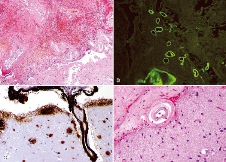 Fig. 26.8, Cerebral amyloid angiopathy (CAA). (A) Surgically evacuated intracerebral hematoma showing numerous thickened and hyalinized vessels in adjacent brain. (B) Leptomeningeal and superficial penetrating vessels with strong fluorescence on thioflavin S stain. (C) Leptomeningeal and superficial penetrating vessels strongly immunoreactive for Aβ-amyloid peptide. (D) Progressive damage to arteries results in a “double-barrel” appearance.