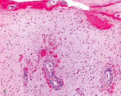 Fig. 26.9, Aβ-amyloid-related angiitis (ABRA). (A) Hyalinized cortical blood vessels are associated with inflammation. (B) Vessel involved by CAA showing associated granulomatous vasculitis (Congo red stain). (C) Aβ-amyloid immunostains highlighting vascular deposits and adjacent diffuse plaques in a case of ABRA. (D) Perivascular T cells are highlighted by a CD3 immunostain.